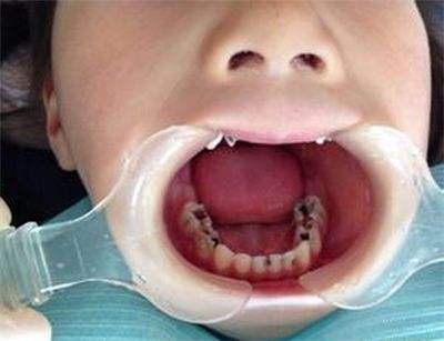 儿童全麻治牙后最常见的后遗症,儿童看牙为什么要全麻