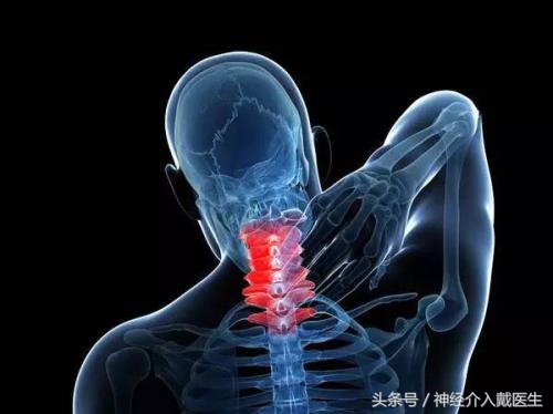 神经根型颈椎病保守治疗方法,颈椎病保守治疗有效吗