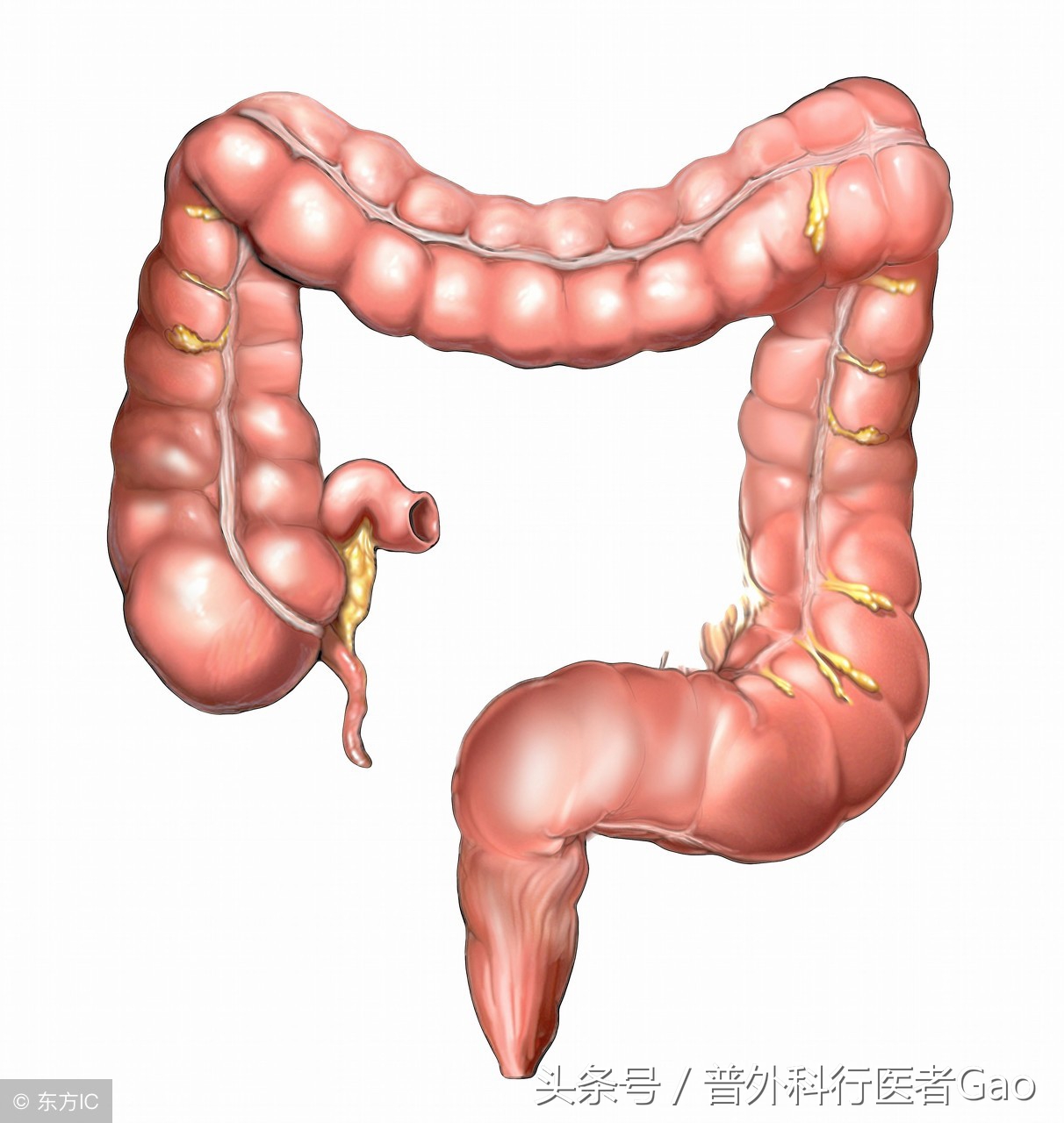 杏仁：一图一话全面解析阑尾的切除过程（干货，不懂医也学习了）
