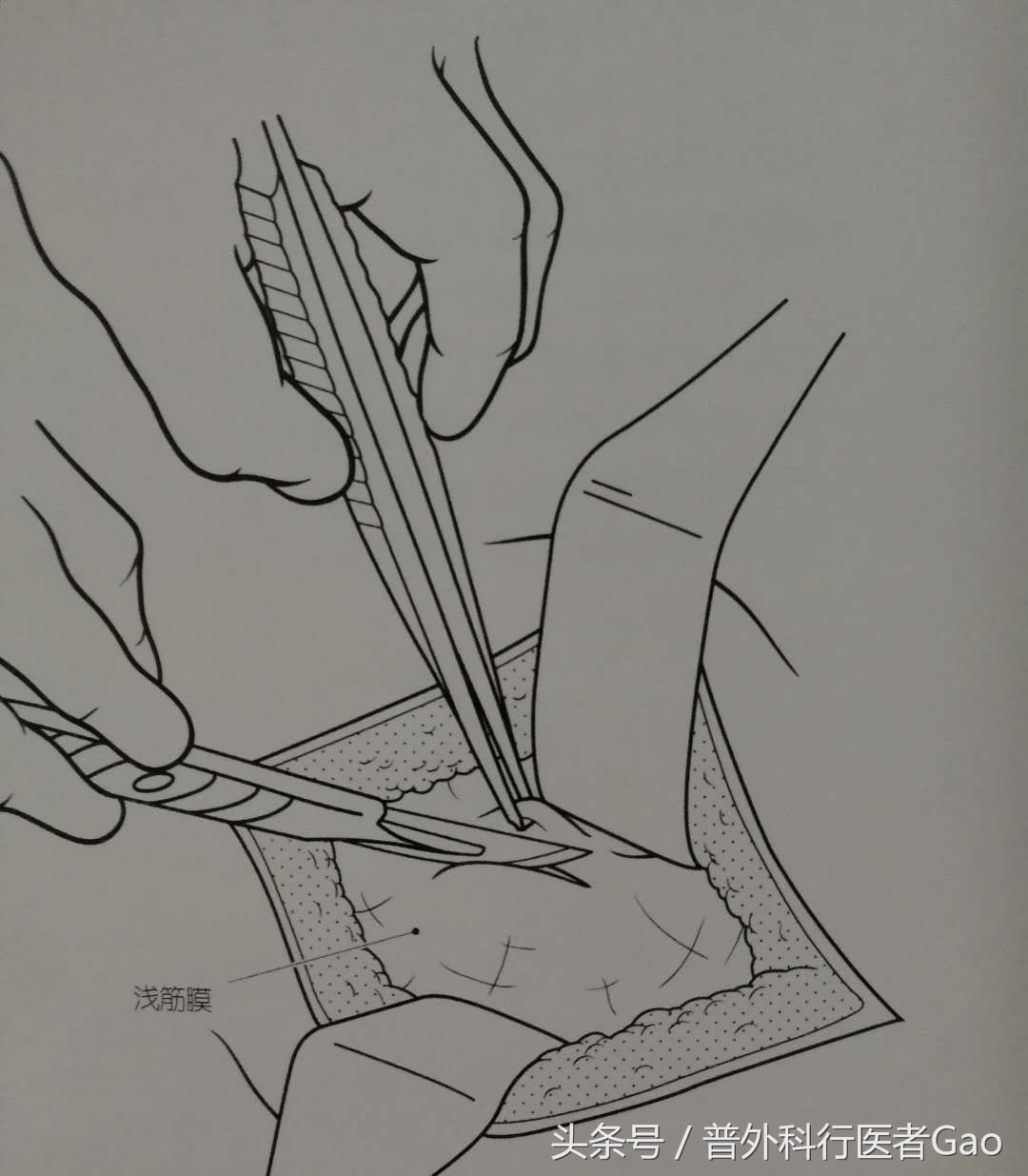 杏仁：一图一话全面解析阑尾的切除过程（干货，不懂医也学习了）