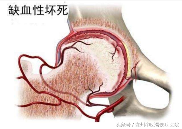 股骨头坏死与坐骨神经痛症状区别,股骨头坏死引起膝关节什么部位痛