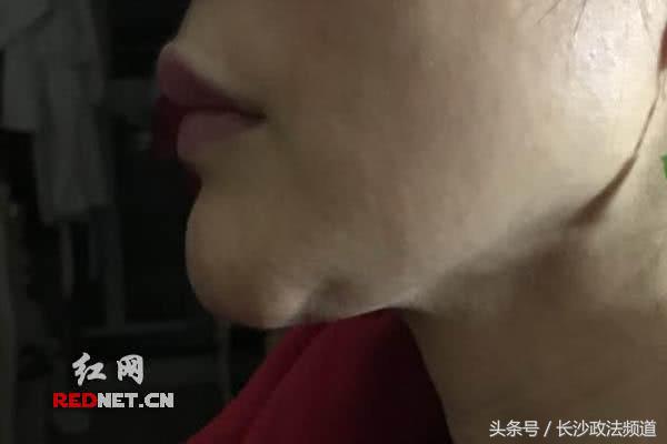 长沙女子整形失败,长沙亚韩整形医院失败案例