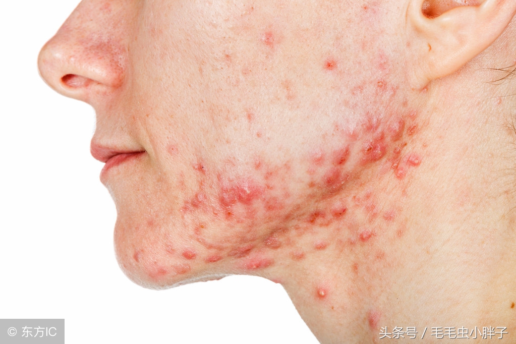 痘痘肌的处理及应对方法,痘痘大作战有没有秘籍