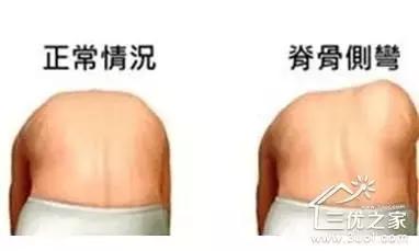 孩子脊柱弯了怎么矫正视频,孩子的脊柱怎么弯
