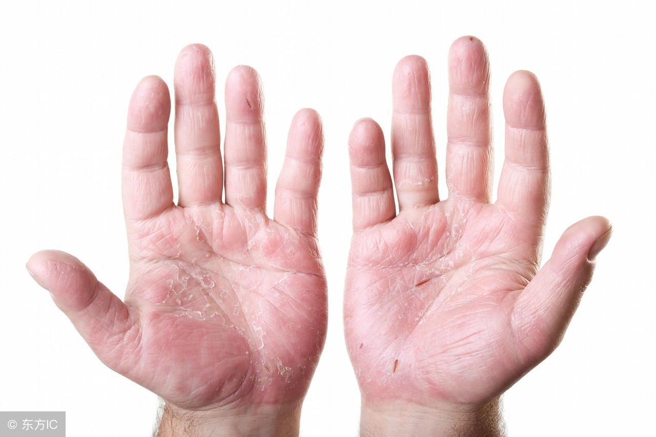 麻疹会难受吗,麻疹会伴随着发热吗