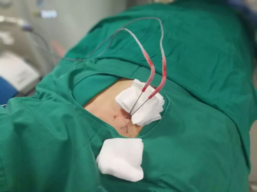 早期肺癌消融治疗和切除效果,氩氦刀冷冻消融术肺癌