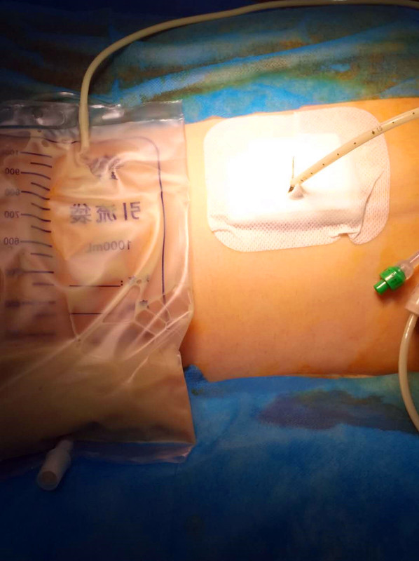 巨大肾结石的标准,巨大肾结石怎么治最好