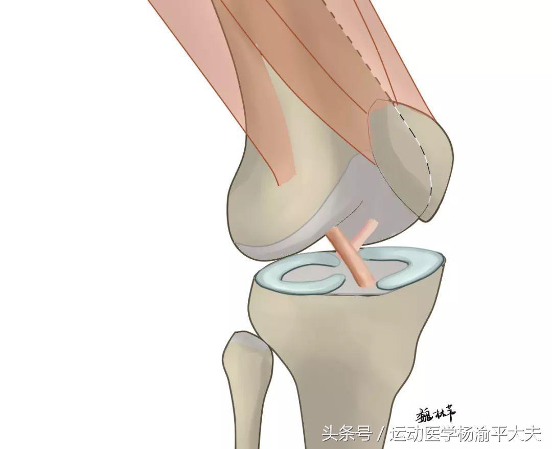 盘状半月板撕裂缝了3针,半月板撕裂应该避免做哪些动作