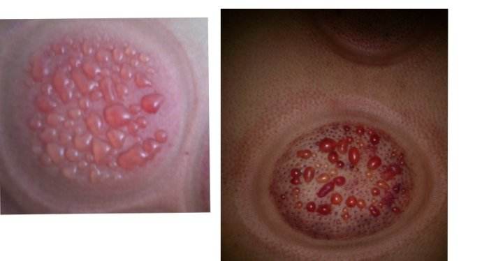 拔火罐印记颜色代表什么,拔火罐黑紫印是什么原理