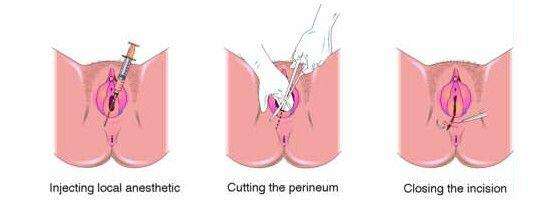 10个顺产9个侧切?关于侧切的这些小常识你必须懂!