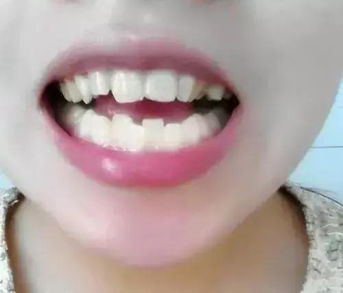 双排牙预防方法,预防孩子双排牙有什么方法