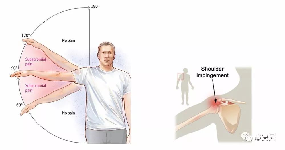 肩峰下撞击综合征的康复评估,肩峰下撞击综合征的康复方法