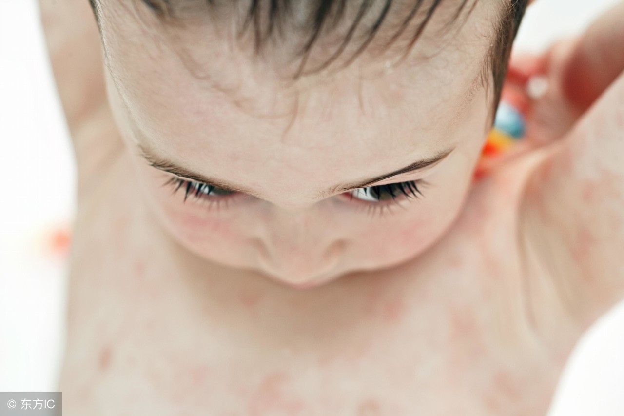 小儿湿疹反复发作，该如何有效防治？速速收藏……