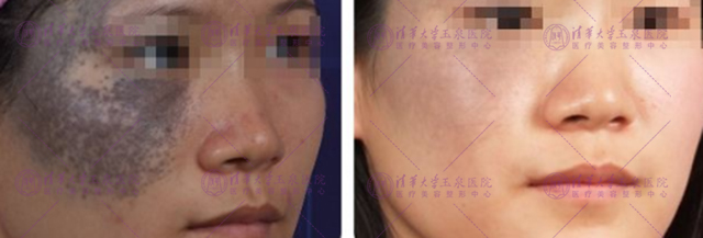 激光祛痣留下坑会长平吗,激光祛痣的疤痕会消失吗