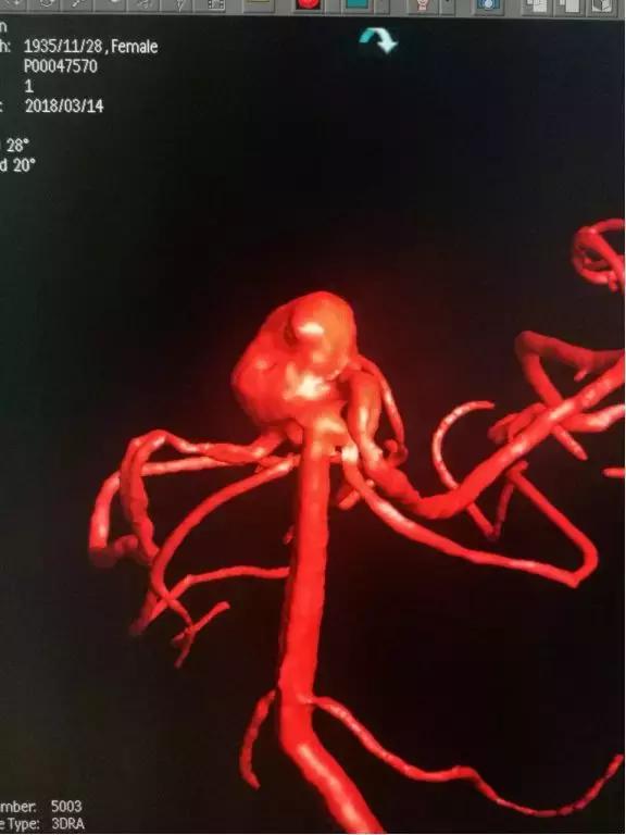 介入栓塞动脉瘤,颅内动脉瘤介入栓塞术全过程