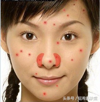 35岁女性脸上反复长痘痘怎么调理,下巴长满痘痘是什么原因怎么调理