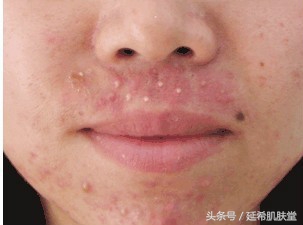 下巴不停冒脓包型痘痘怎么样调理,下巴长满痘痘是什么原因怎么调理