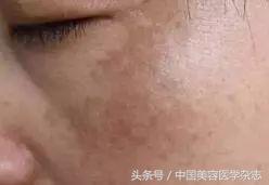 褐青斑和褐青色痣有什么区别,褐斑和褐青色痣区别