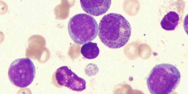 一家四口患白血病的真实原因,一家四口患白血病