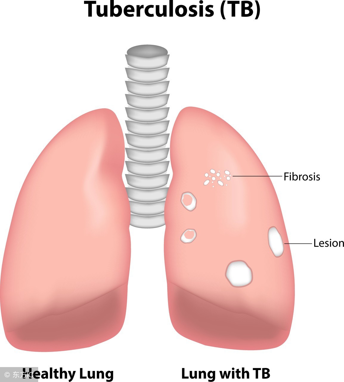 肺结核杆菌是什么杆菌,肺结核空洞里面有曲霉菌