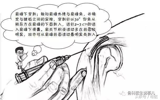 爬楼梯关节痛可以吃消炎药吗,爬楼梯股关节痛