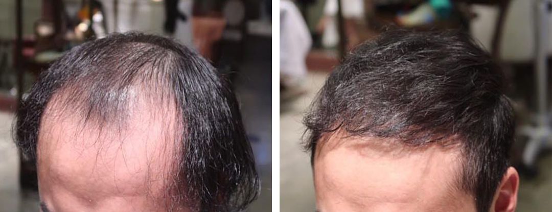 圆脸发际线高的男生适合什么发型,发际线高头发稀少发型男