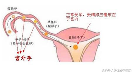 孕早期出血怎么办伴有血块,孕早期绒毛膜下出血