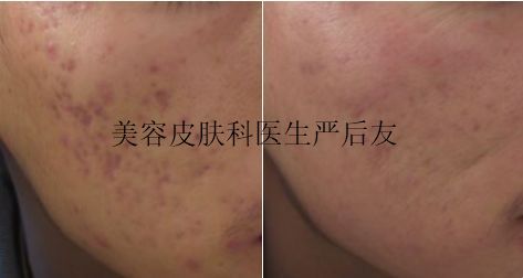 皮肤科修复痘坑大全,痘印痘坑修复皮肤科医生