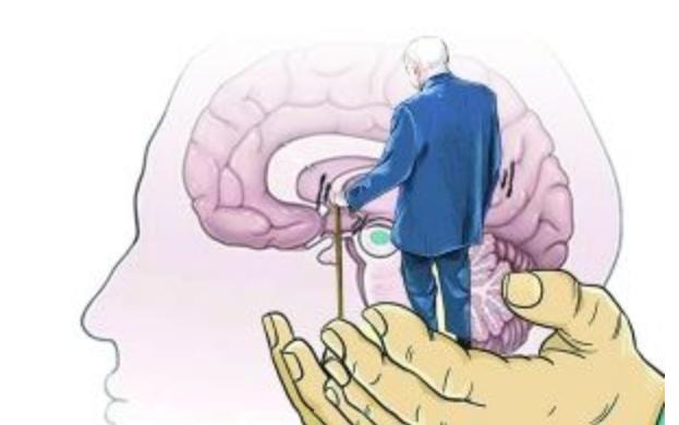 帕金森综合症是神经出问题吗,帕金森综合征是什么