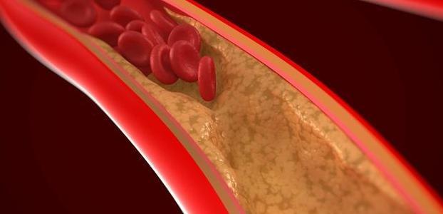 甘油三酯高为什么会造成动脉硬化,动脉硬化指数和甘油三酯高吃什么