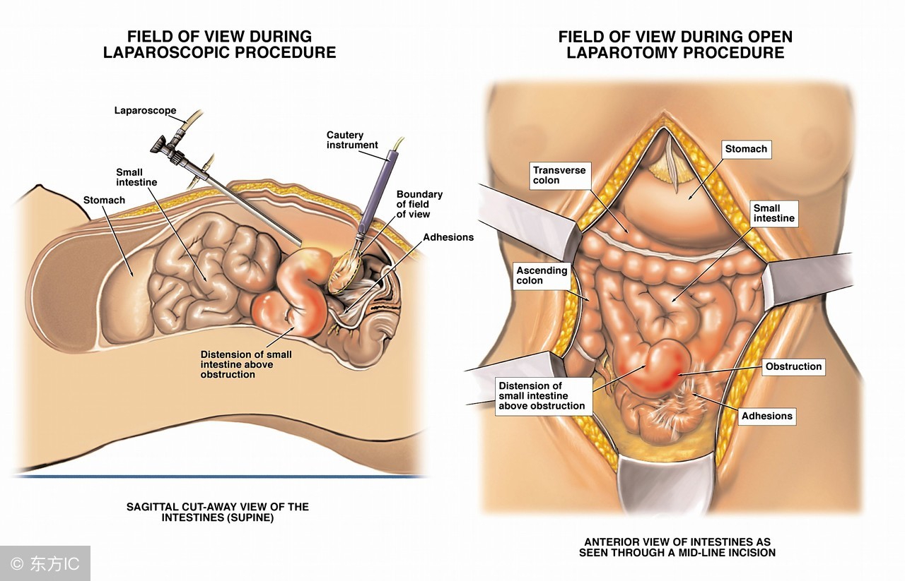 结肠癌并转移到肺肝胃还能活多久,结肠癌伴肠周淋巴结肿大