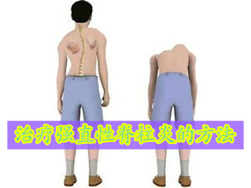 有哪几种治疗强直性脊柱炎的方法