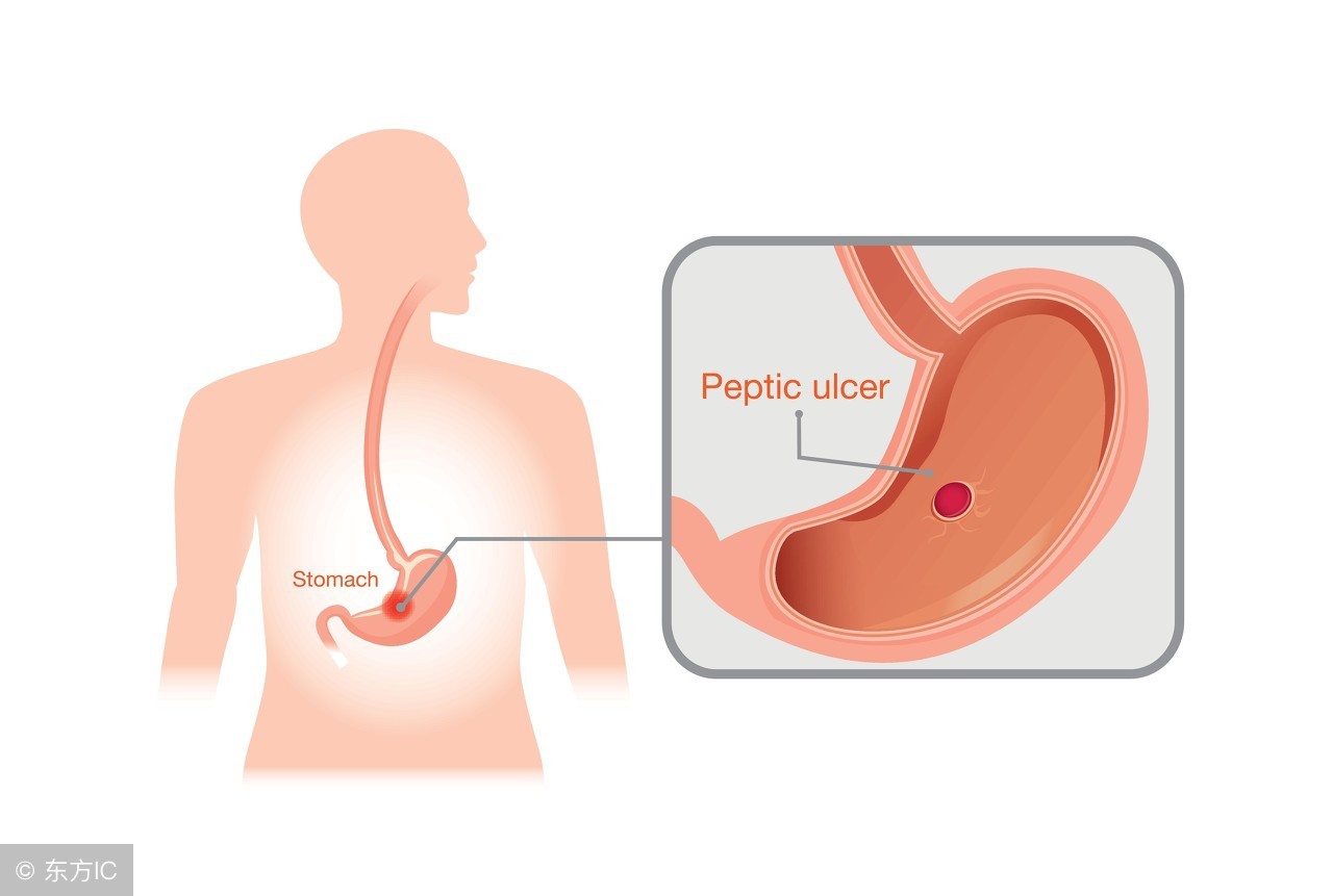 胃癌免疫治疗进展综述,胃癌的免疫治疗