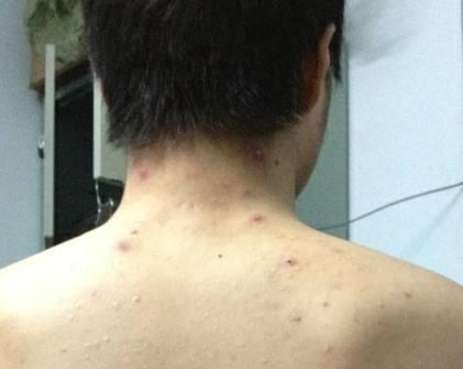 后背长了一个螨虫大疙瘩怎么去除,两天不洗澡就后背长痘痘是螨虫吗