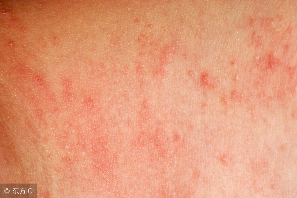 脂溢性皮炎毛囊炎外用药哪个好用,脂溢性皮炎头皮屑多用什么外用药