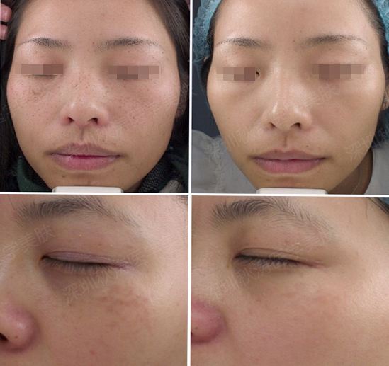 对于激光祛斑，你又了解多少？