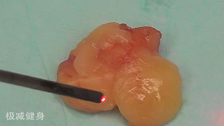 抽脂减肥的五大误区,减肥抽脂的过程是怎样的