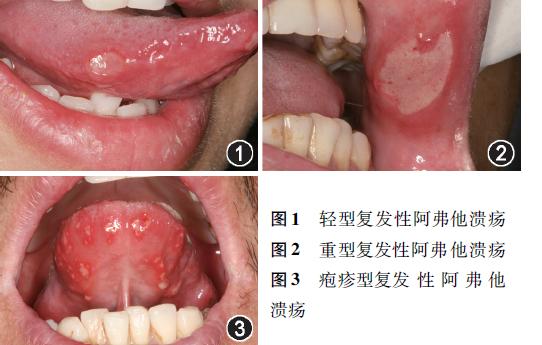 牙疼伴有口腔溃疡服用什么药物,免疫异常引起口腔溃疡吃什么药物
