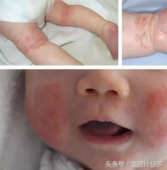 宝宝反复湿疹对付湿疹有妙招,宝宝湿疹反反复复的最佳治疗方法