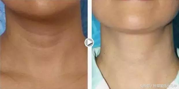 深度剖析医美整形的危害,医美整形该如何避坑呢