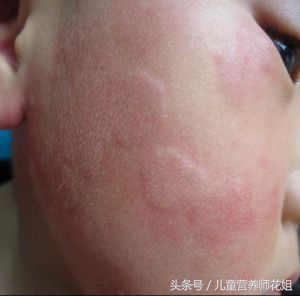 荨麻疹成因和根治方法,麻疹和荨麻疹有什么区别能治好吗