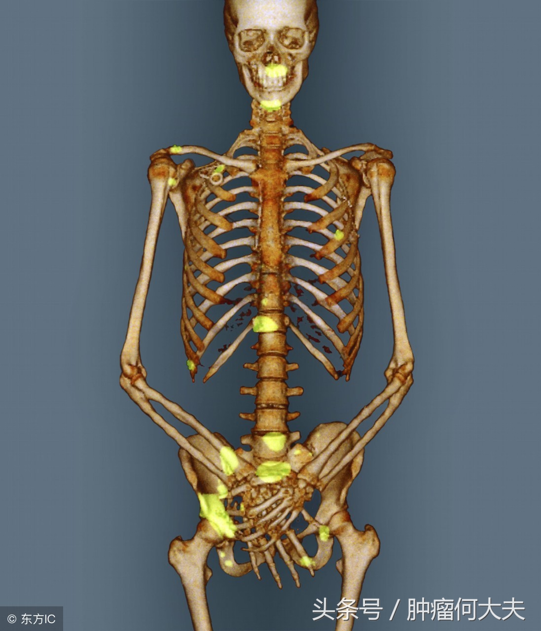 骨转移癌如何形成？治疗方法是什么？预后如何？