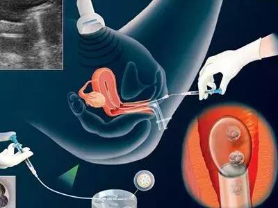 20岁女大学生捐卵,女大学生捐卵案