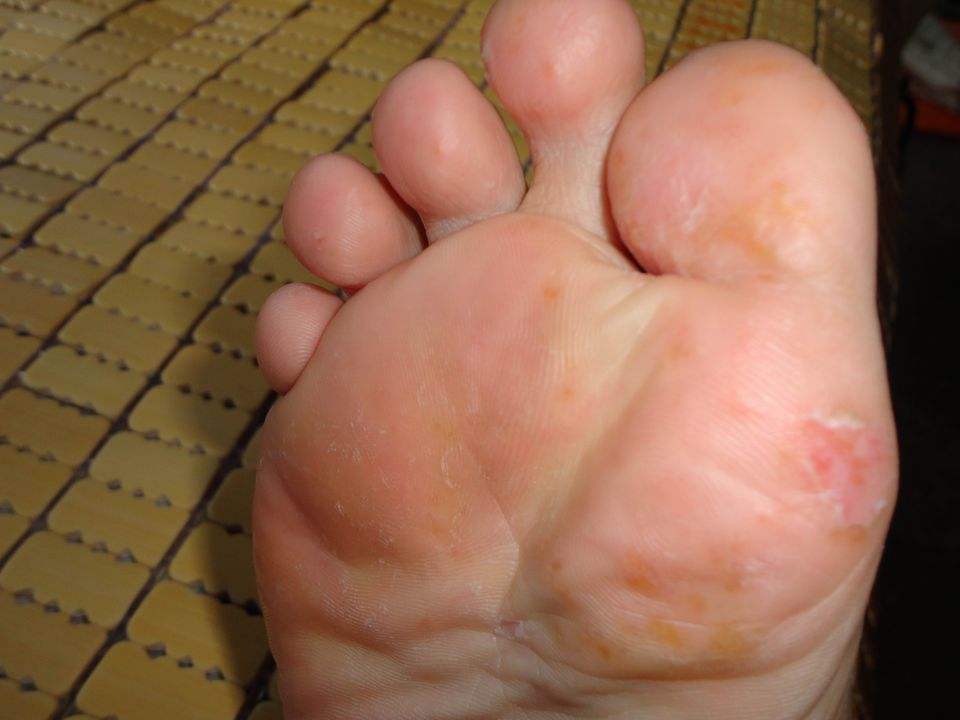 脚上磨出的水泡怎么处理好得快,脚上磨出的水泡怎么消得快