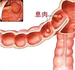胃肠息肉切除后饮食,胃肠息肉怎么治用什么药