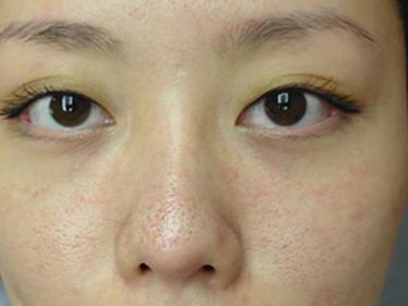 去黑头草莓鼻最有效的方法,怎么去黑头不会变草莓鼻