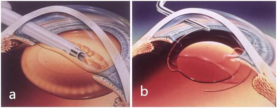 白内障要成熟才可以做手术吗,白内障成熟到什么程度做手术最好