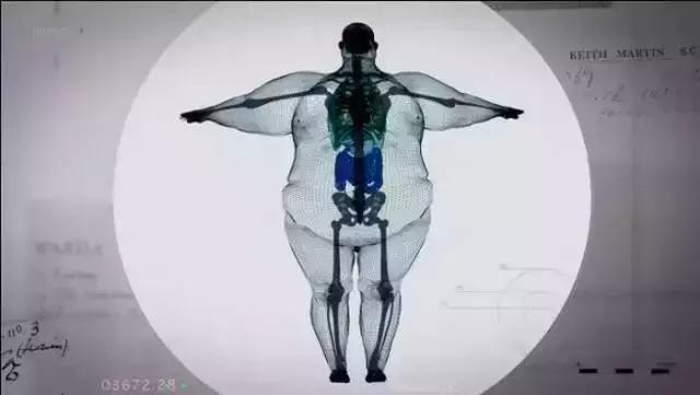 盘点X光透视下的人体异物,看着都痛!