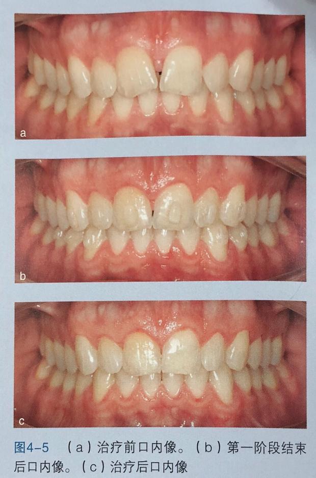 牙齿上的黑三角怎么才能清洗干净,去除牙齿黑三角的神器