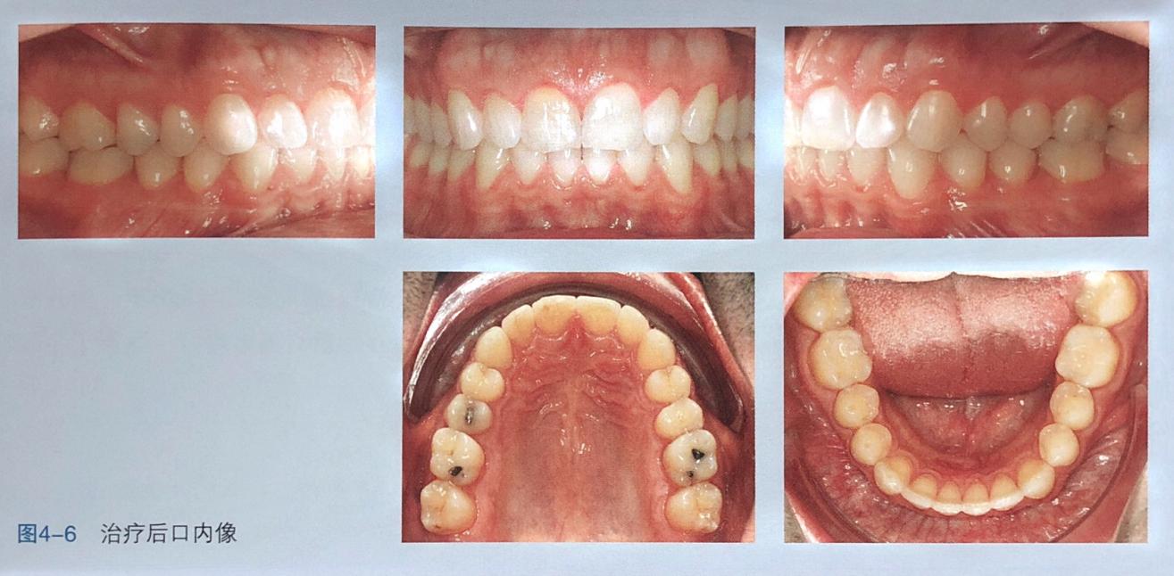牙齿上的黑三角怎么去除,去除牙齿黑三角的神器